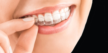 Clear Aligners Image