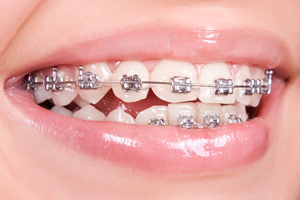 Braces to correct space between upper and lower teeth